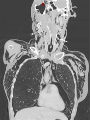 Severe respiratory distress secondary to pharyngeal perforation during endoscopic gastrostomy tube removal: a clinical case report